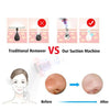 Blackhead Removal Suction Tool: Gentle and Effective Skin Cleansing - Aquan Express